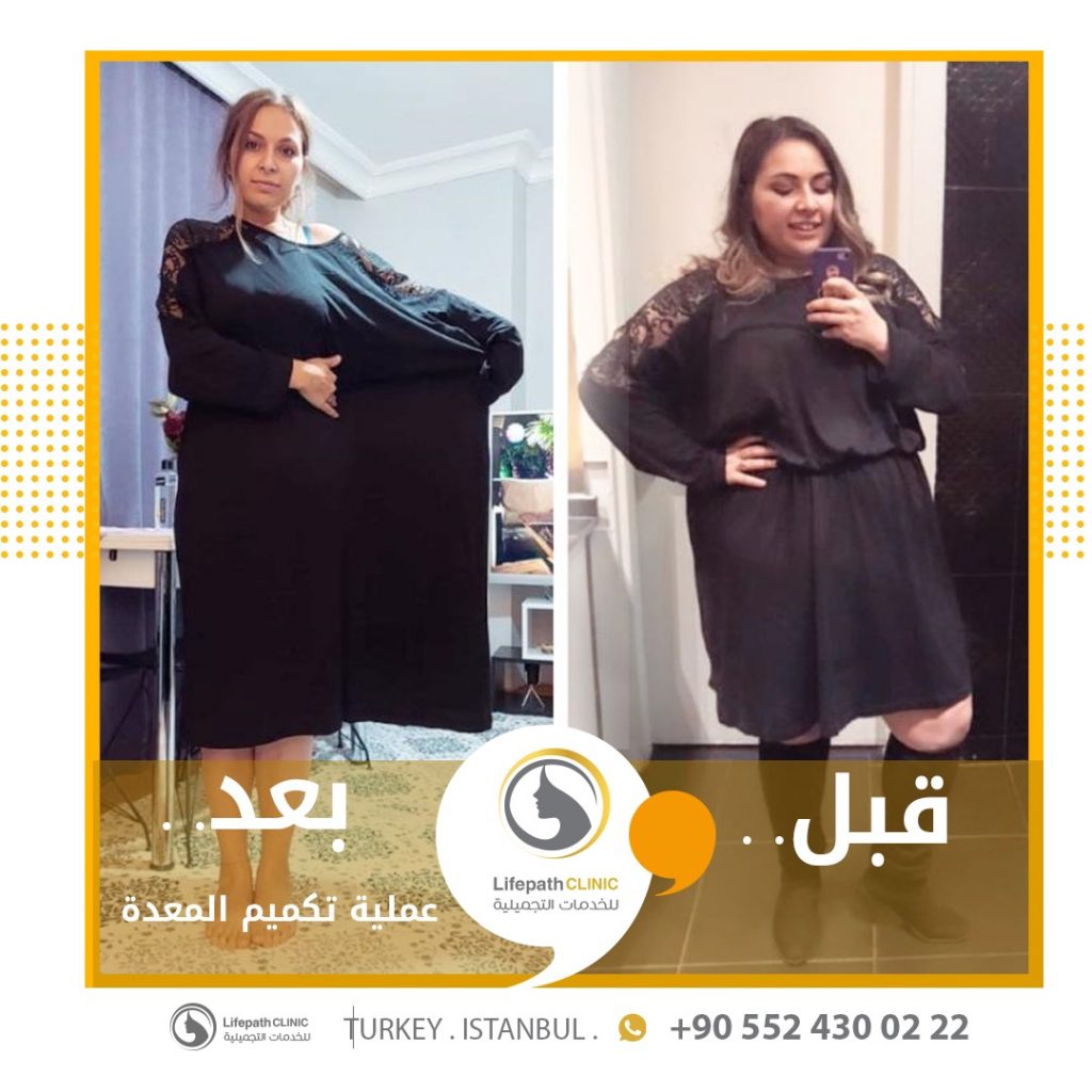 لايف باث كلينك - تكميم المعدة