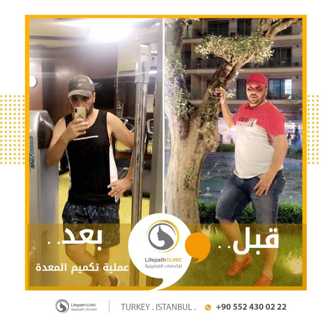 لايف باث كلينك - قص المعدة