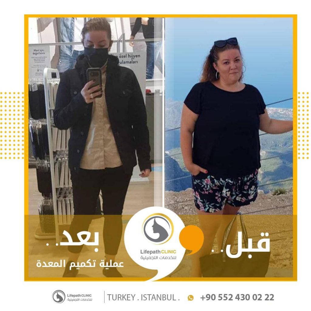 لايف باث كلينك - نتيجة عملية تكميم معدة