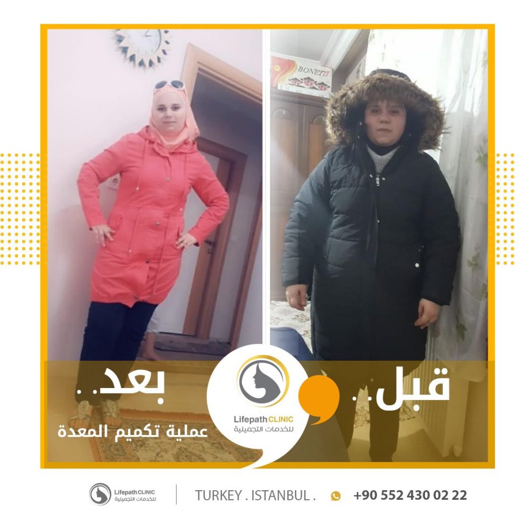 لايف باث كلينك - تكميم المعدة في تركيا