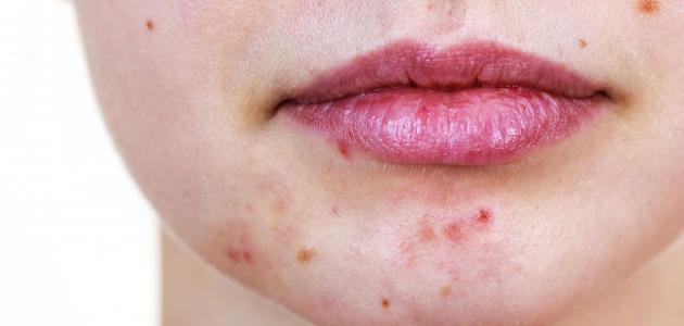 استراتيجيات لعلاج حب الشباب