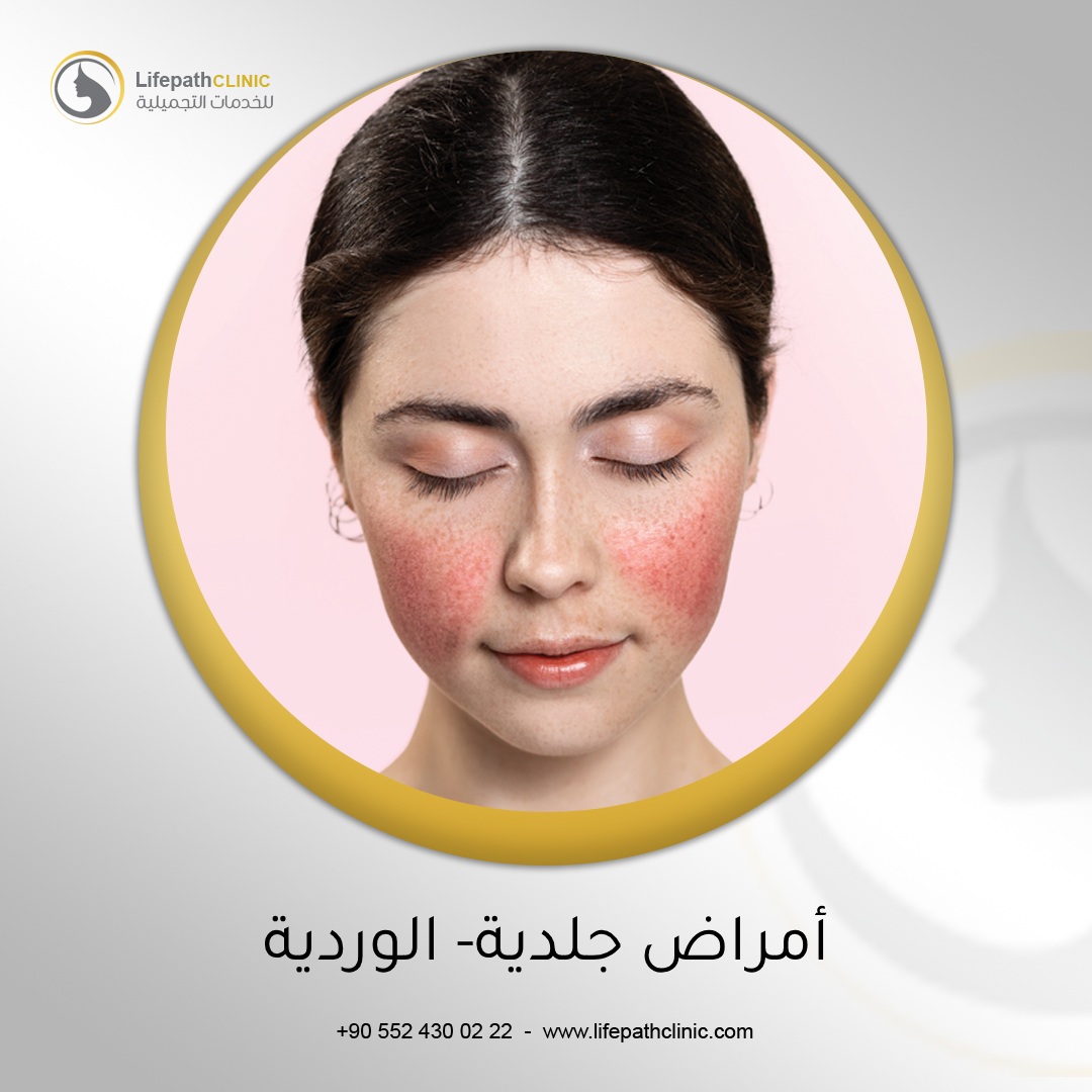 أمراض جلدية - الوردية