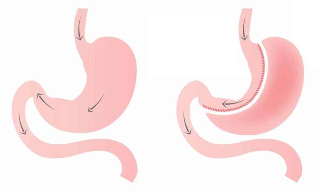 هل عملية تكميم المعدة أفضل من اتباع نظام غذائي
