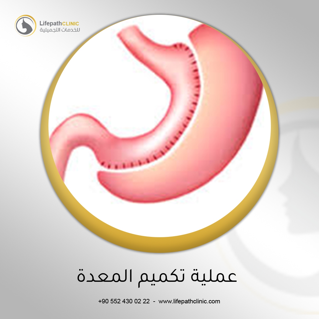 هل عملية تكميم المعدة أفضل من اتباع نظام غذائي