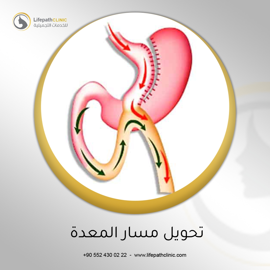 عملية تحويل مسار المعدة تعيد تعريف الجوع وعادات الأكل