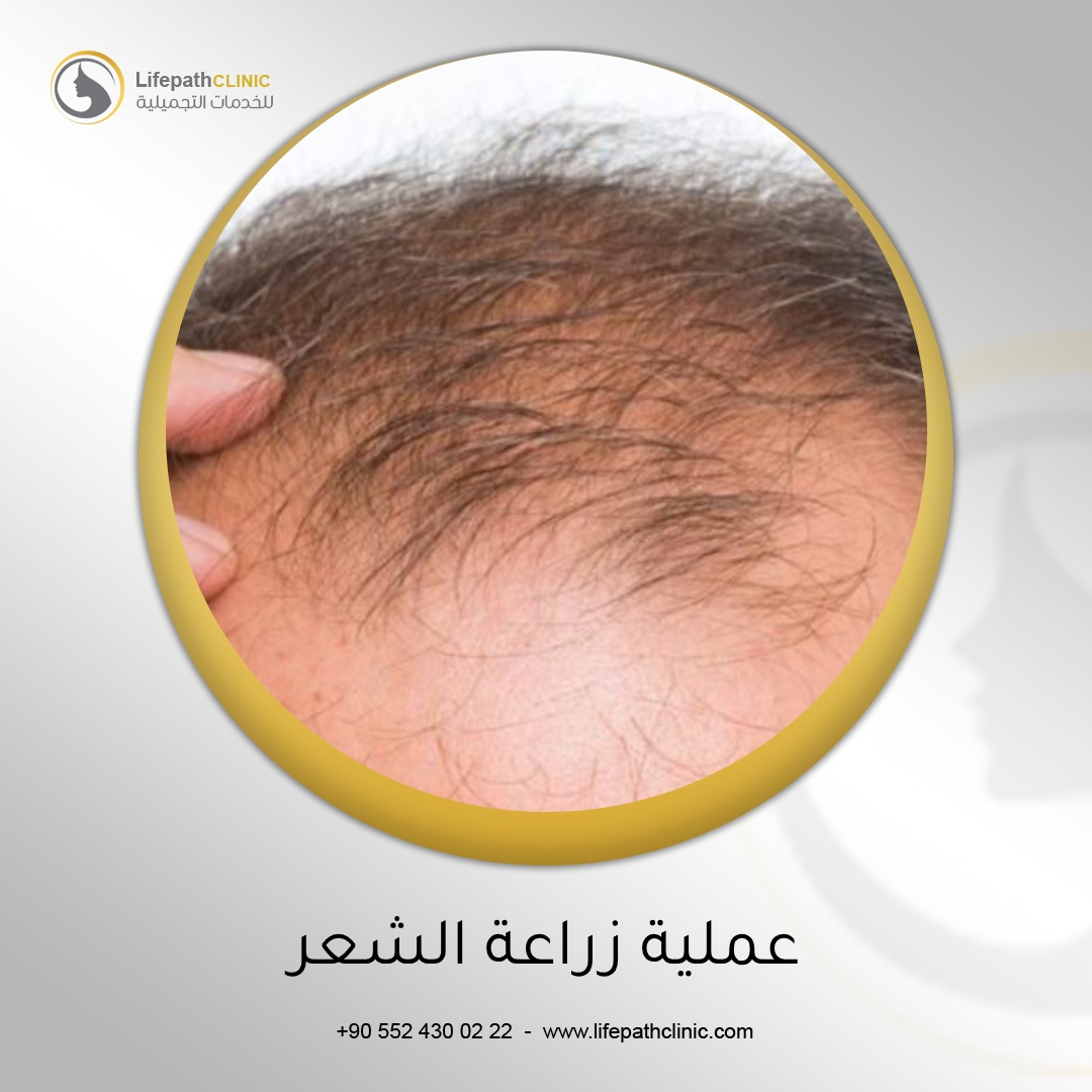 عملية زراعة الشعر