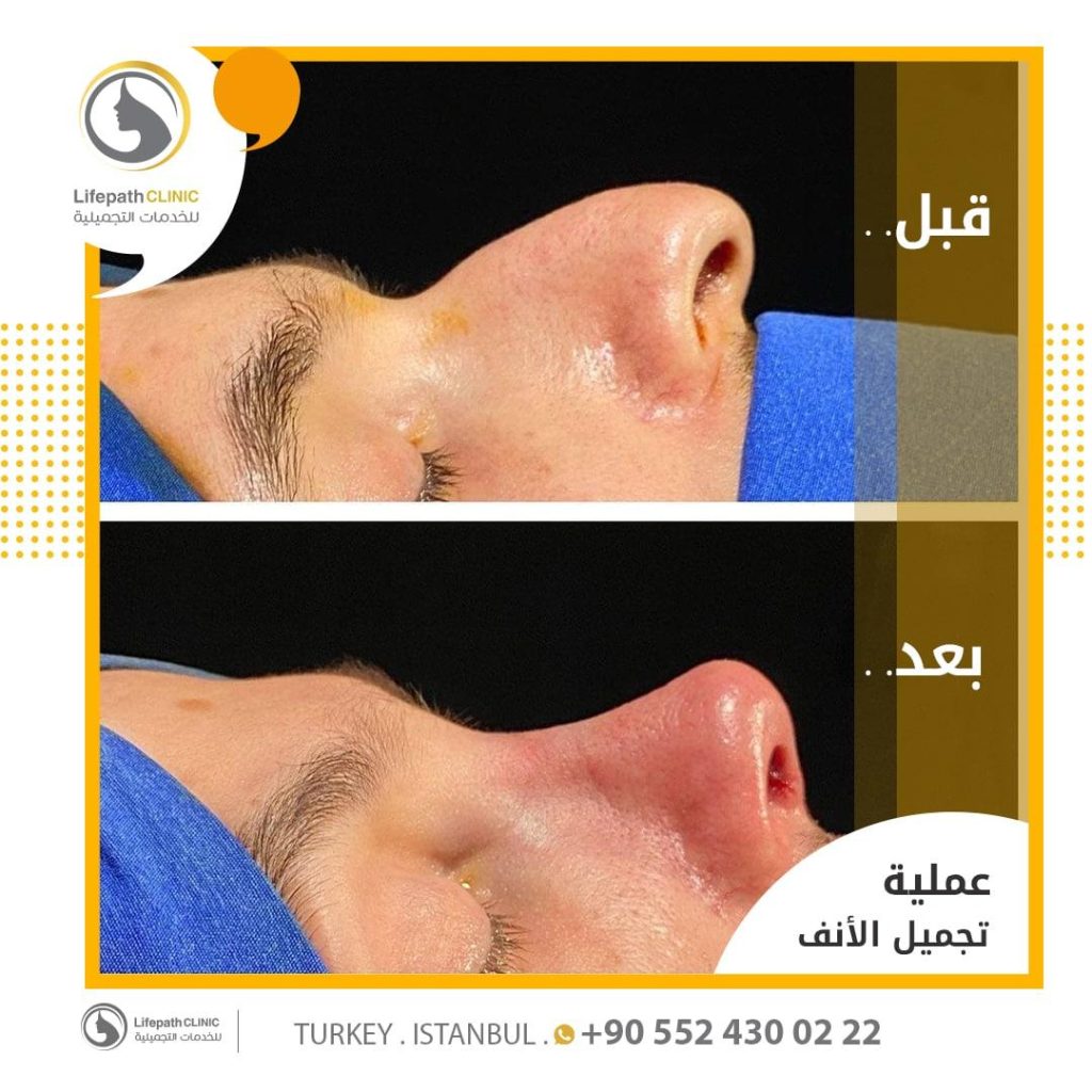 تجميل الأنف