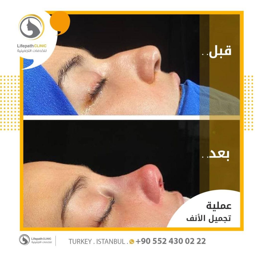 تجميل الأنف