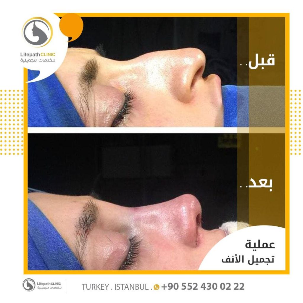 تجميل الأنف