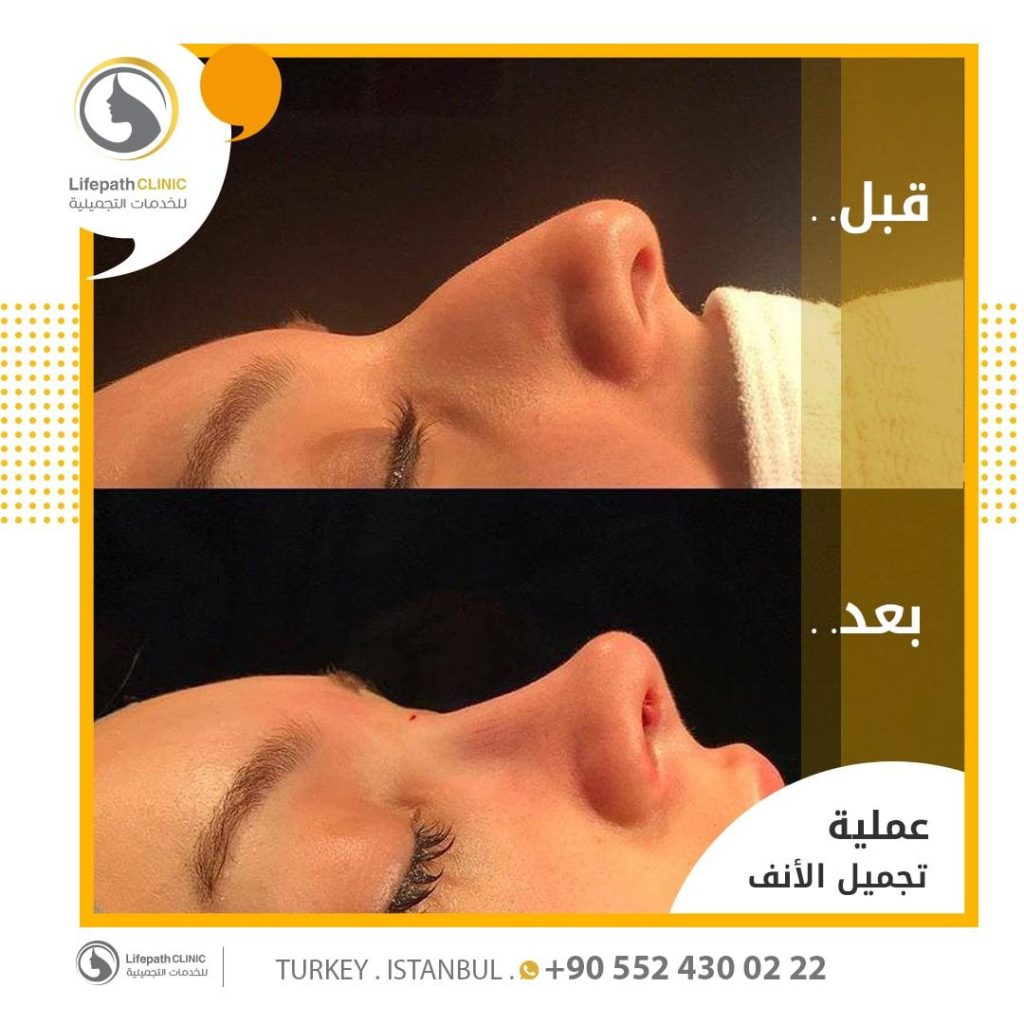صور عملاء لايف باث كلينك قبل و بعد عملية تجميل الأنف