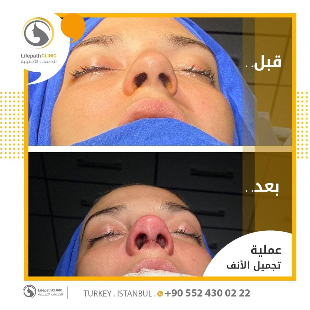نتائج عمليات تجميل الأنف في لايف باث كلينك 