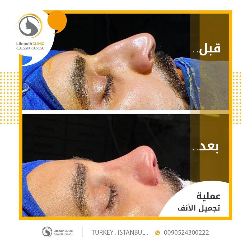 نتائج عمليات تجميل الأنف في لايف باث كلينك 