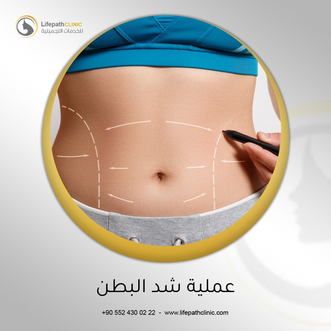 عملية شد البطن