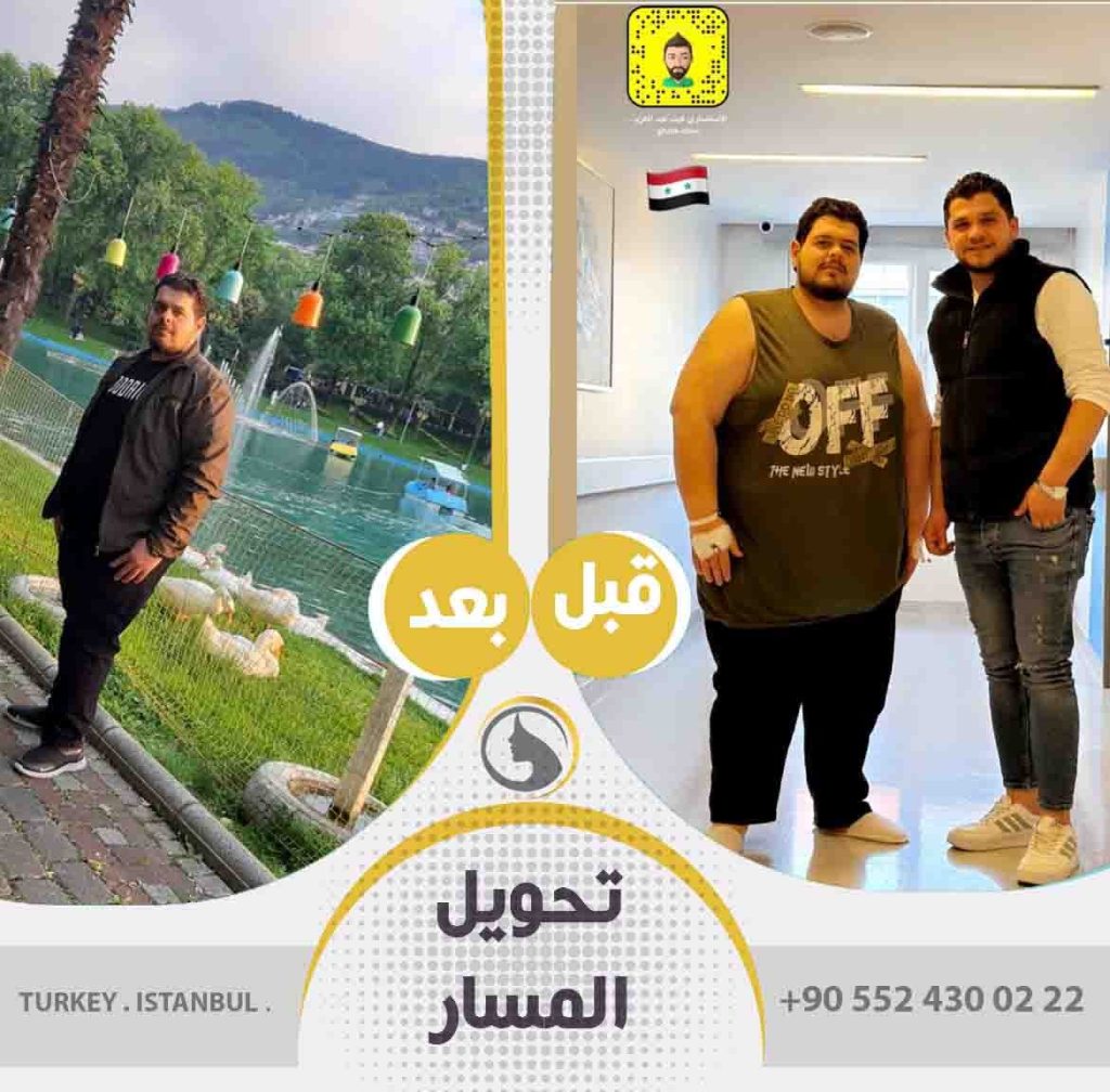 صور عملاء باث لايف كلينك قبل و بعد تحويل مسار المعدة