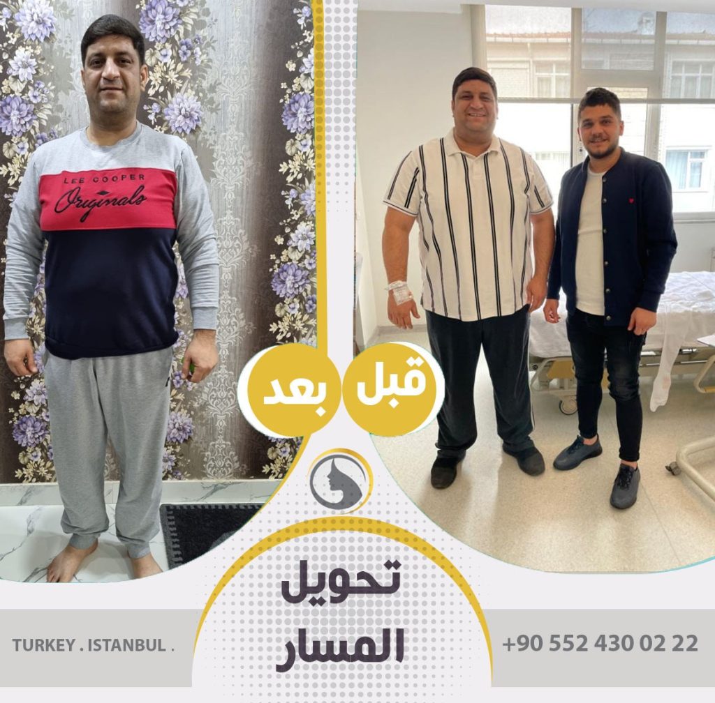 صور عملاء باث لايف كلينك قبل و بعد تحويل مسار المعدة