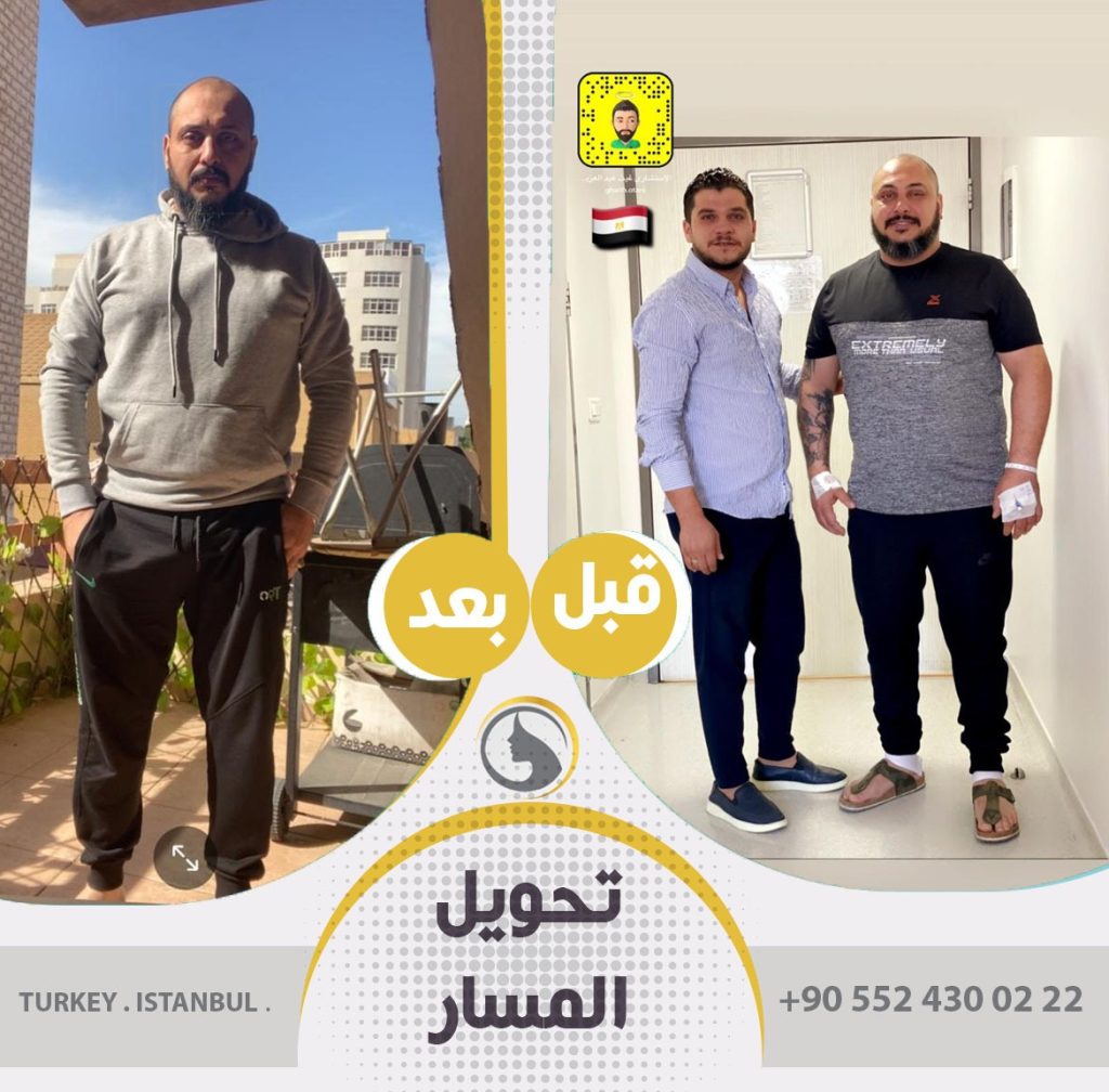 صور عملاء باث لايف كلينك قبل و بعد تحويل مسار المعدة