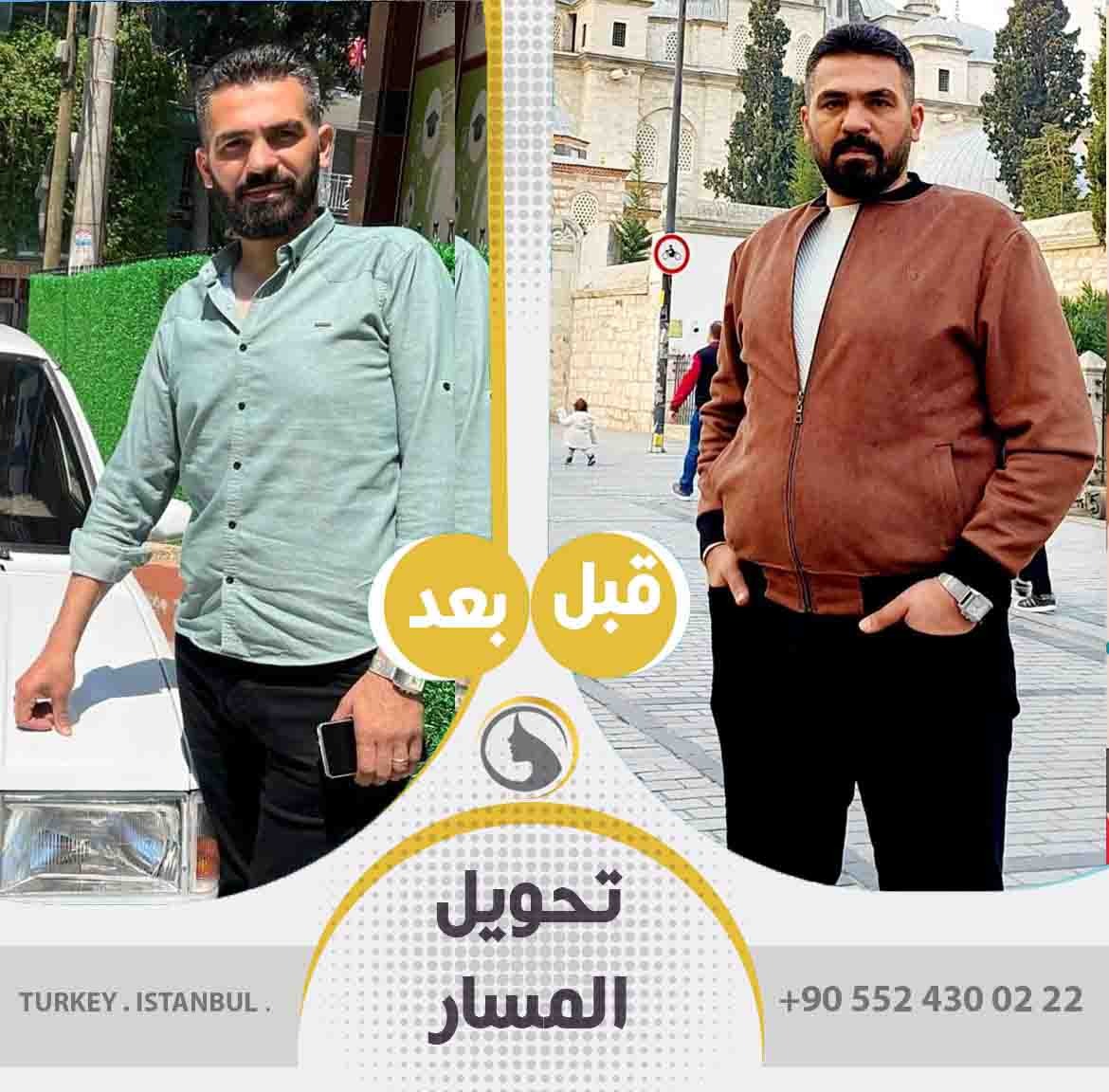 قبل و بعد تحويل مسار المعدة