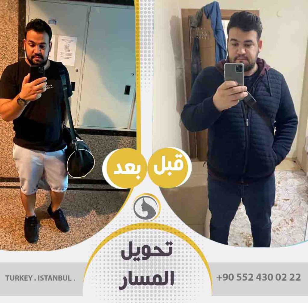 صور عملاء باث لايف كلينك قبل و بعد تحويل مسار المعدة