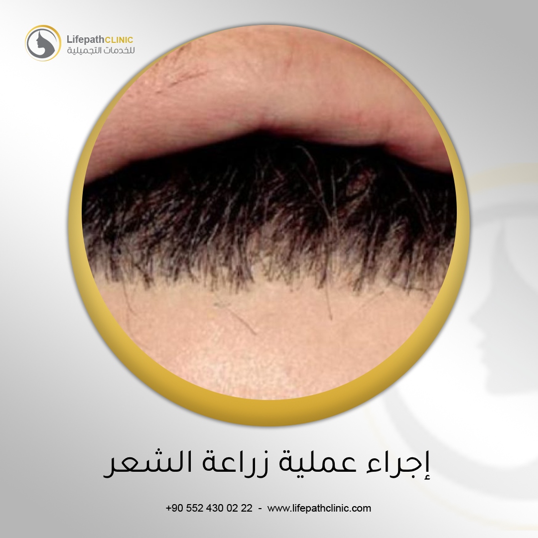 إجراء عملية زراعة الشعر: ما يمكن توقعه خلال الأسبوع الأول
