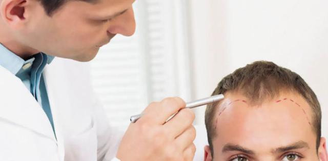 إجراء عملية زراعة الشعر: ما يمكن توقعه خلال الأسبوع الأول