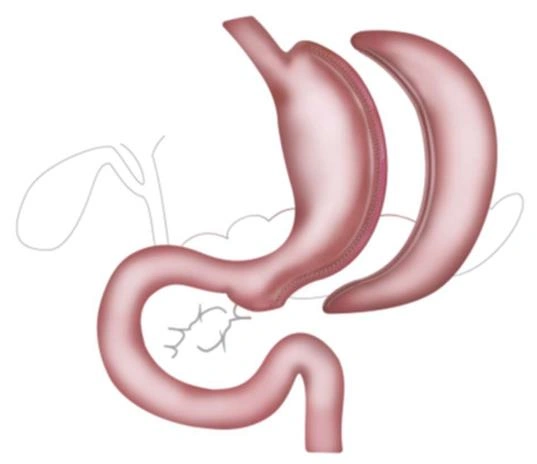 تحويل مسار المعدة المصغر