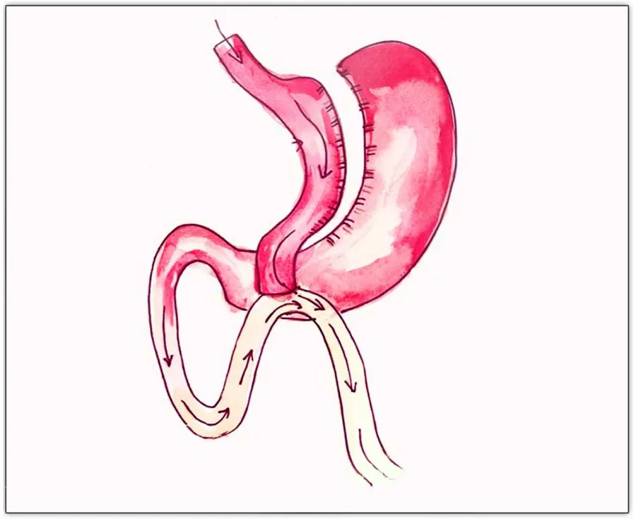 تحويل مسار المعدة المصغر