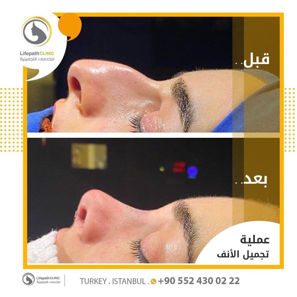 نتائج عمليات تجميل الأنف في لايف باث كلينك