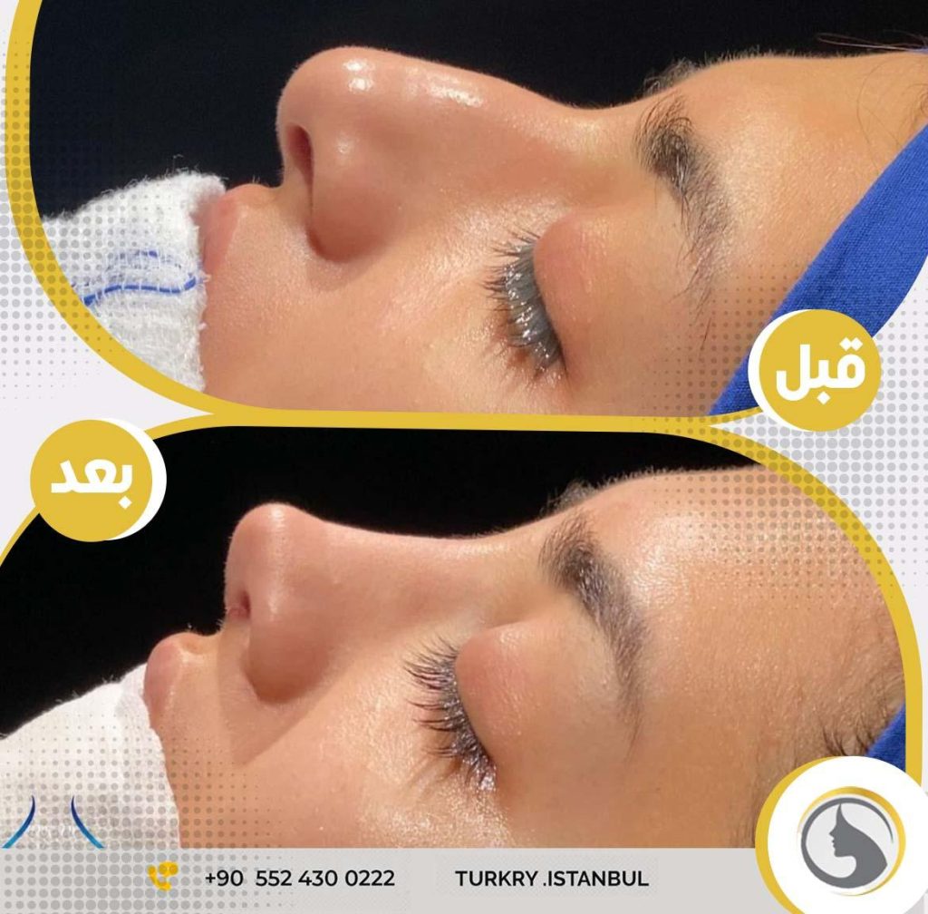 نتائج عمليات تجميل الأنف في لايف باث كلينك