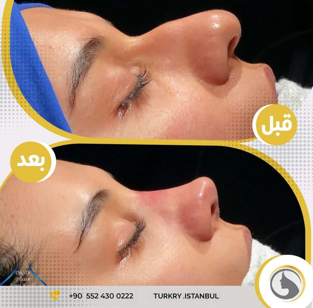 عملية تجميل الأنف