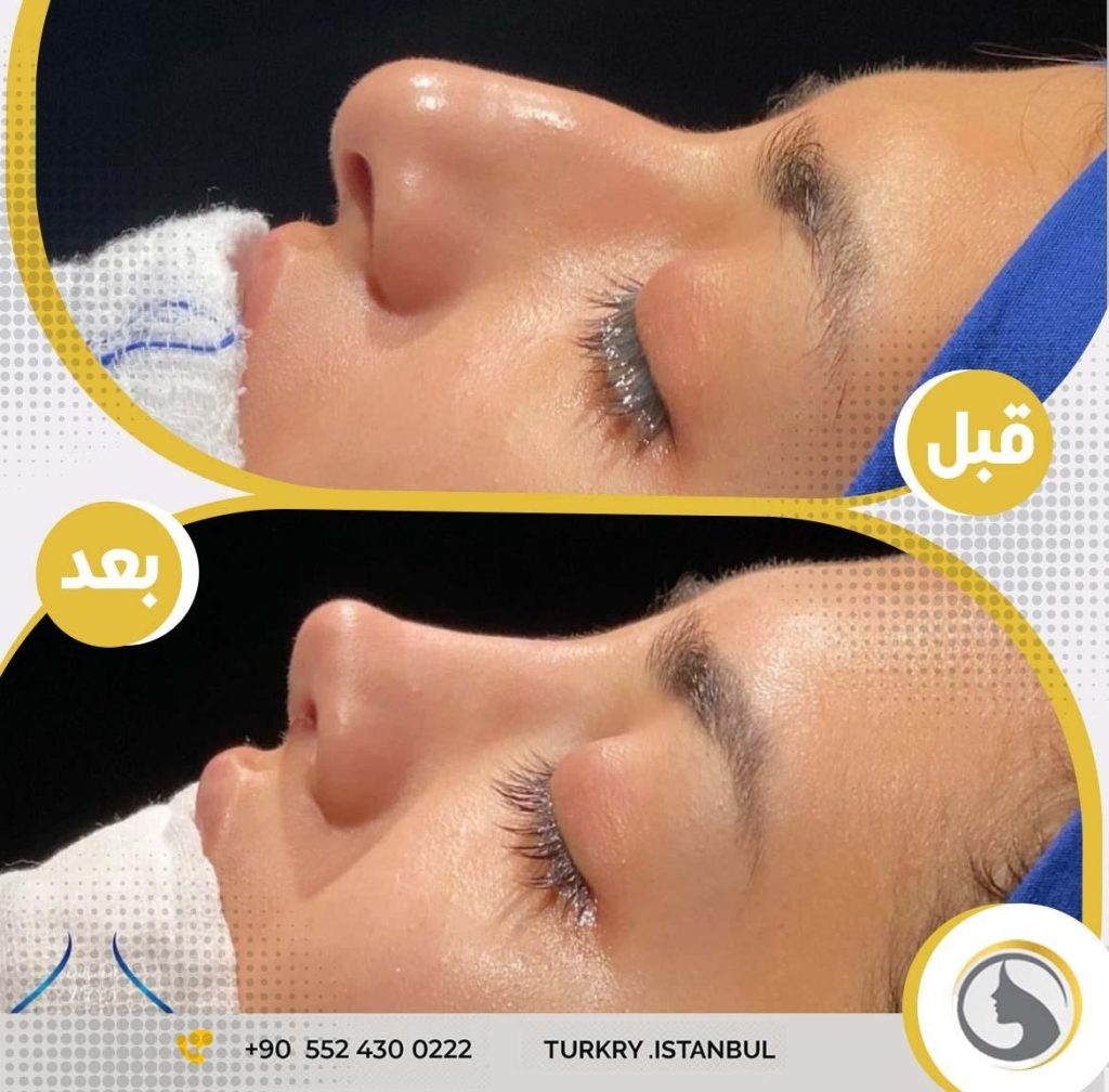 عملية تجميل الأنف