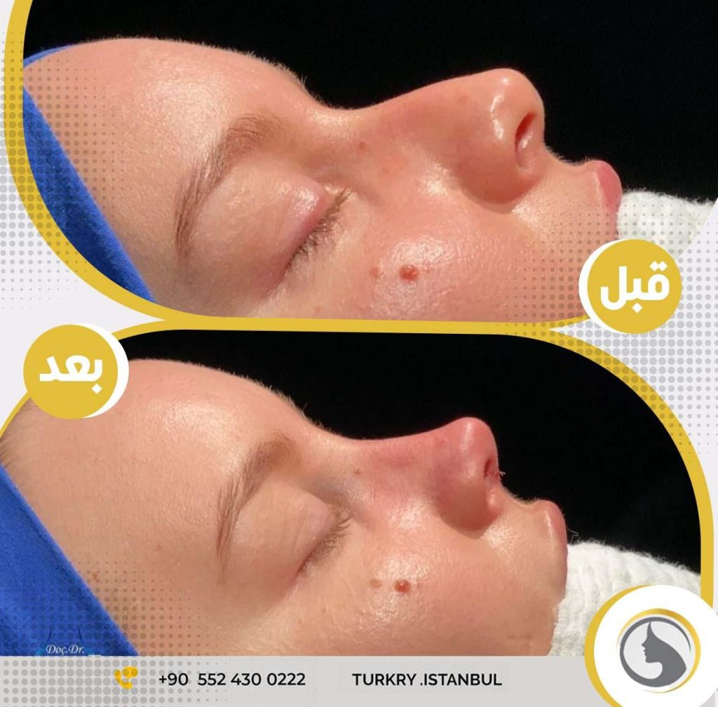 من عملية تجميل الأنف