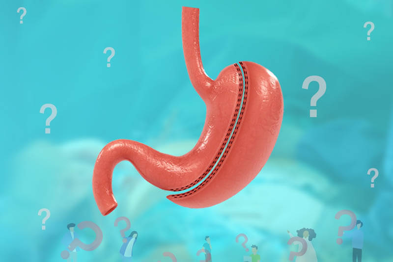 نصائح للنجاح على المدى الطويل بعد جراحة تكميم المعدة