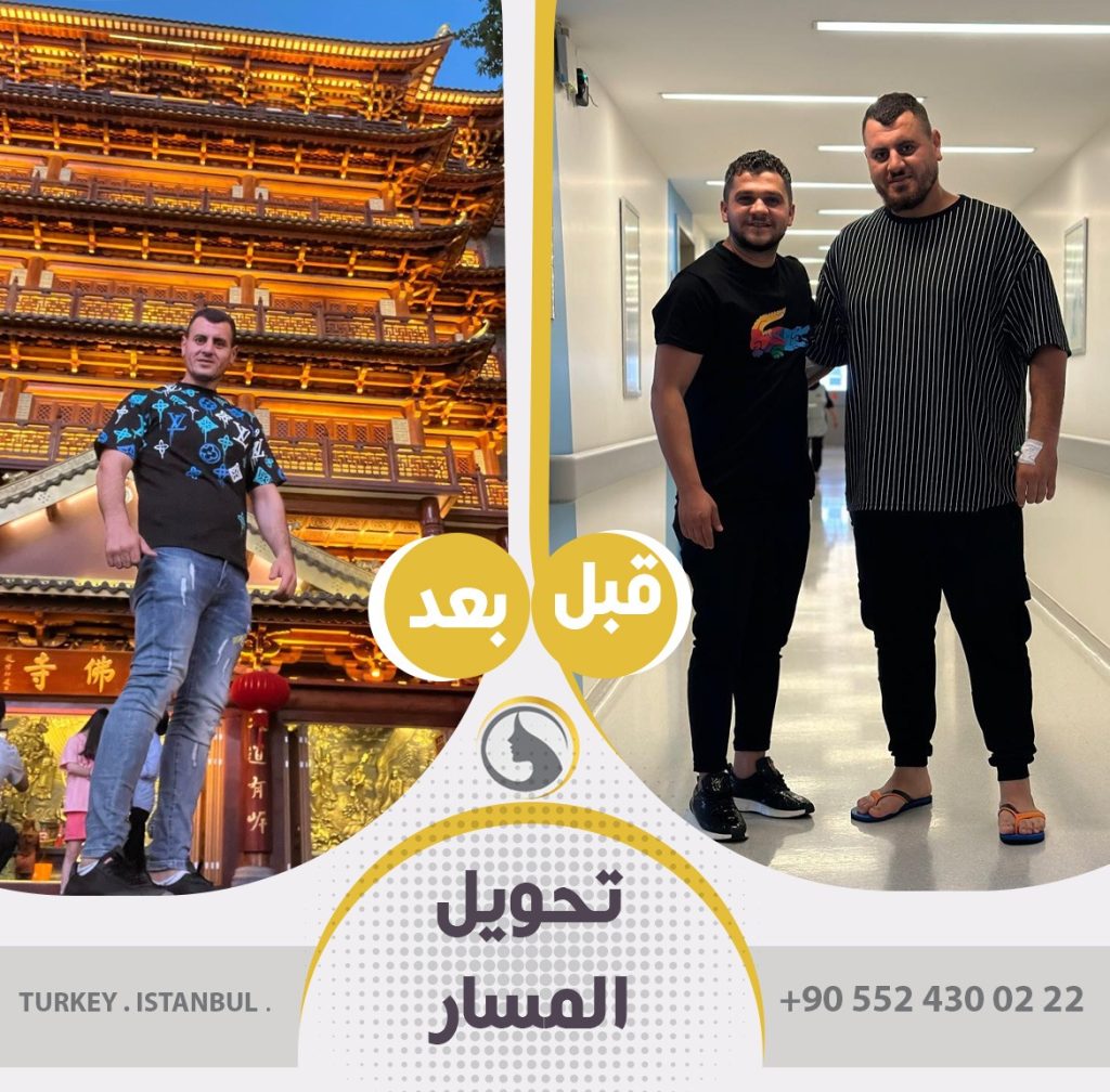 قبل وبعد عملية تحويل مسار المعدة