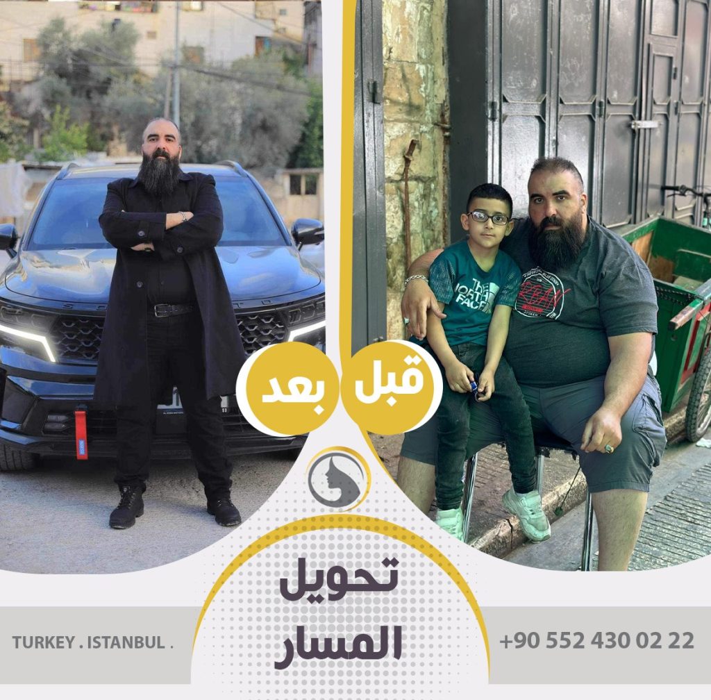 قبل وبعد عملية تحويل مسار المعدة