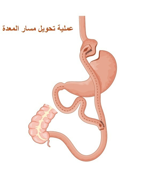 تحويل مسار المعدة الكلاسيكي و المصغر