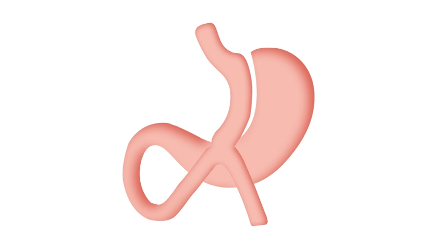 تحويل مسار المعدة الكلاسيكي و المصغر