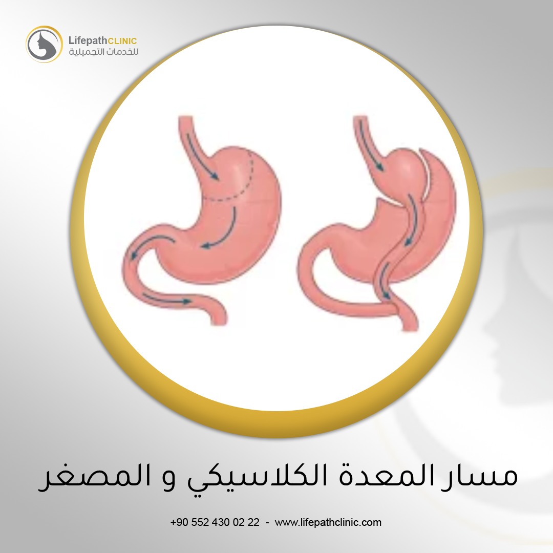 الفرق بين تحويل مسار المعدة الكلاسيكي و المصغر