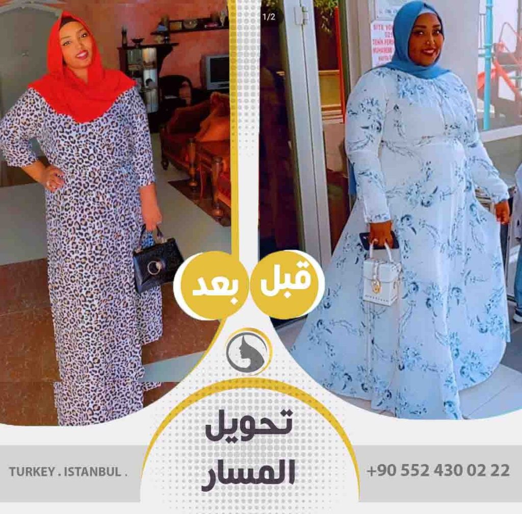 عملية تحويل مسار المعدة