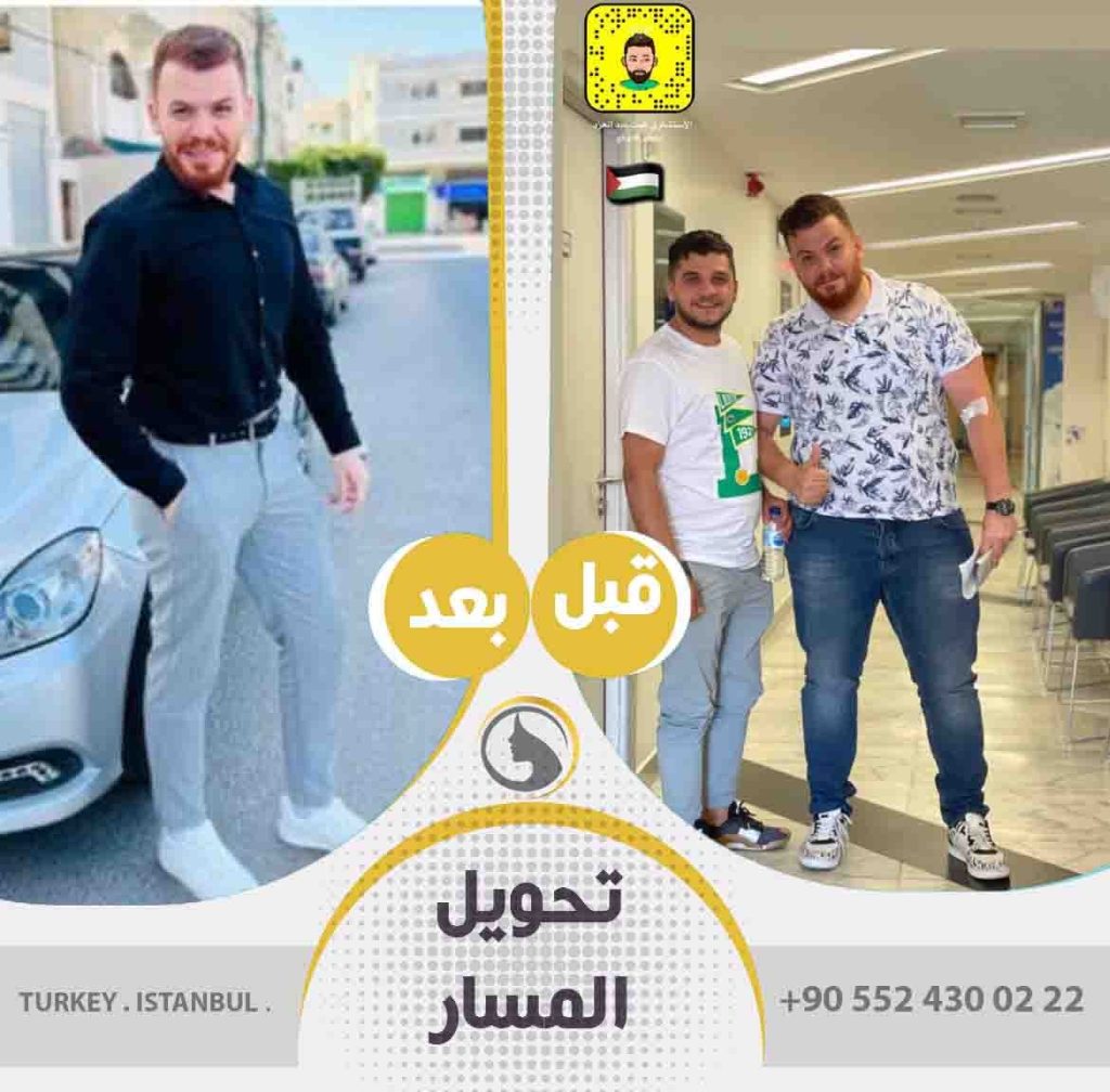 عملية تحويل مسار المعدة