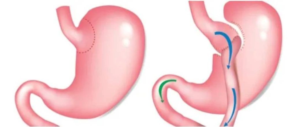 تحويل مسار المعدة: أمل جديد لمرضى السكري
