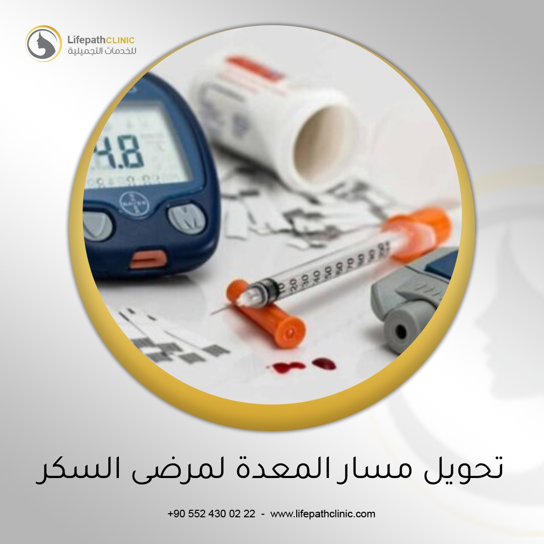 تحويل مسار المعدة: أمل جديد لمرضى السكري