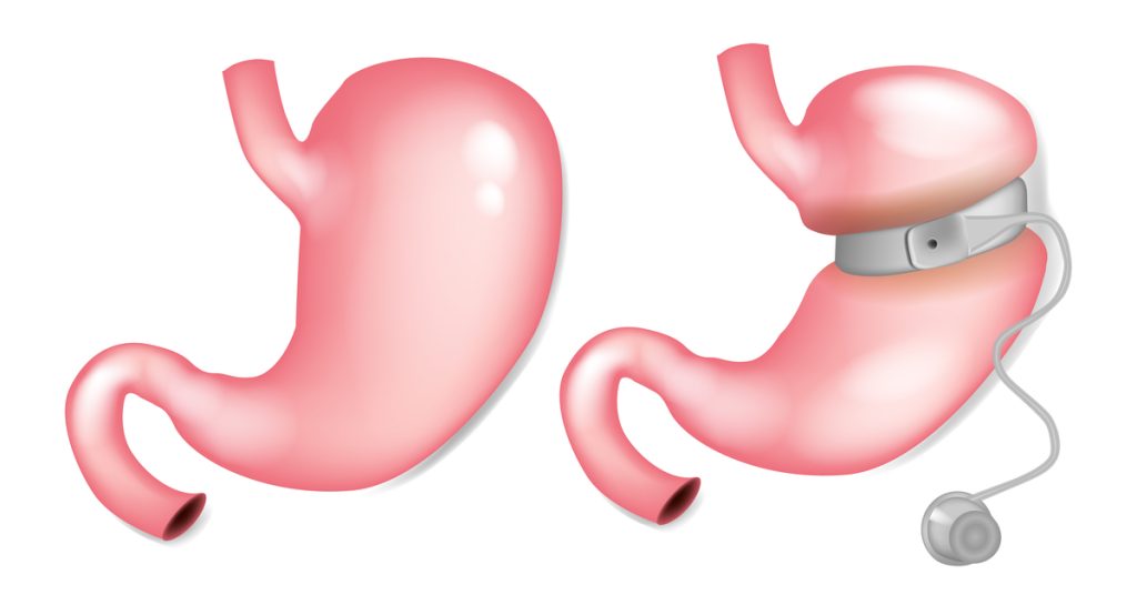 جراحة السمنة: استكشاف الخيارات المتاحة أمامك