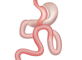 علاقة عملية تحويل مسار المعدة بتحسين النوم وتقليل الألم