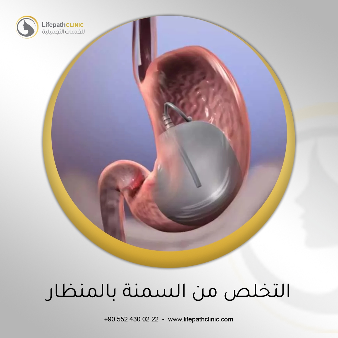 التخلص من السمنة بالمنظار