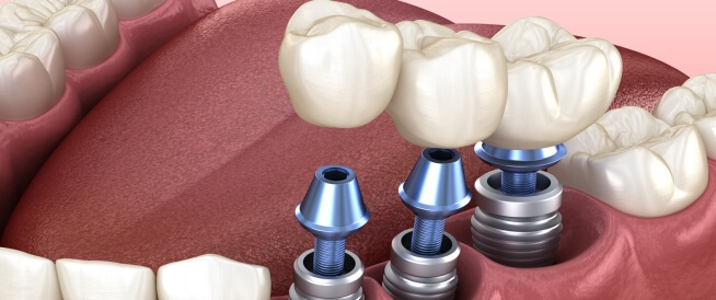 أسئلة ومخاوف شائعة حول زراعة الأسنان