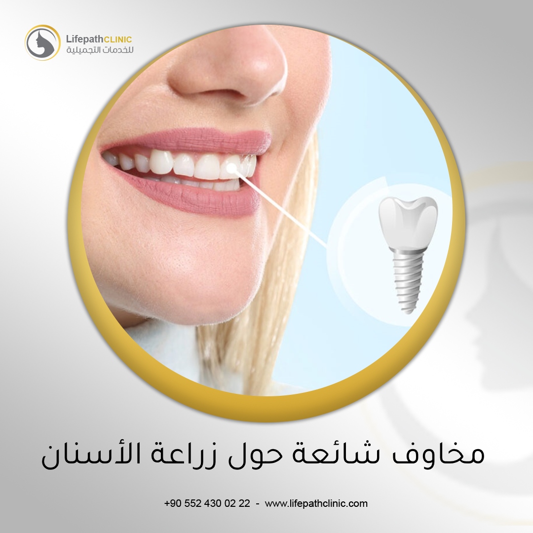 مخاوف شائعة حول زراعة الأسنان