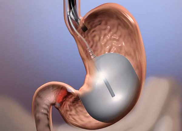 جراحة بالون المعدة
