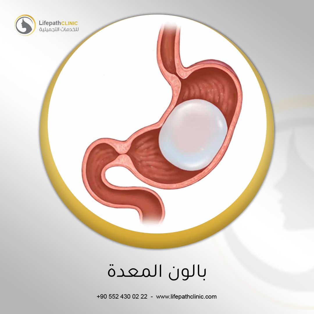 جراحة بالون المعدة