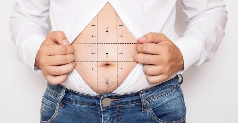 العناية بالجروح والندوب بعد جراحة السمنة