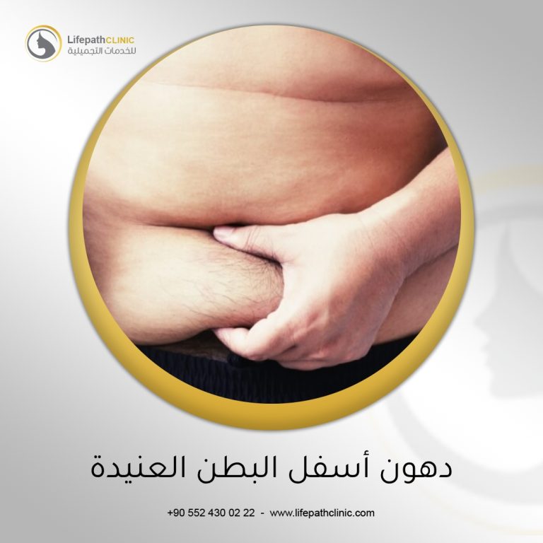 دهون أسفل البطن العنيدة